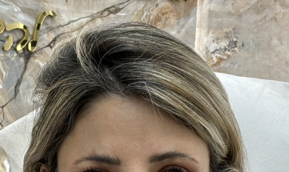 מצח חלק ורענן אחרי טיפול בוטוקס בפרפקטו קליניק