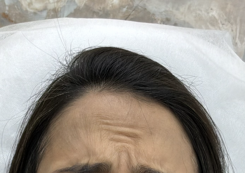 קמטי מצח רוחביים לפני טיפול בוטוקס